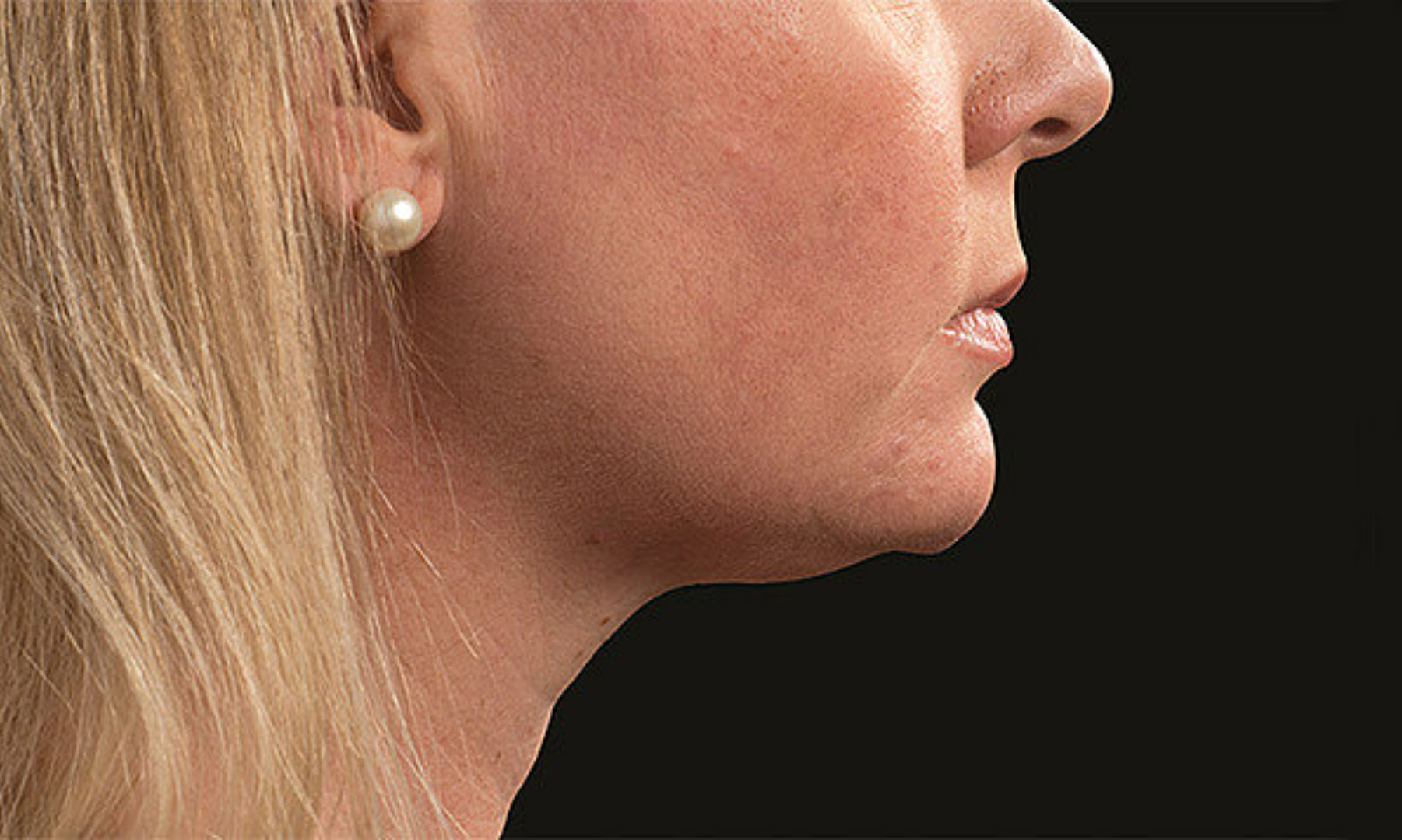 CoolSculpting After woman chin