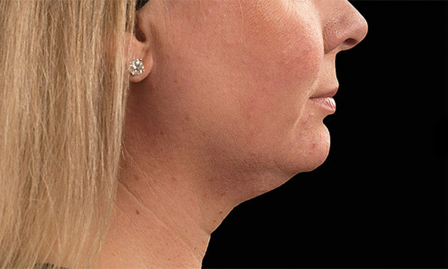 CoolSculpting Before woman chin