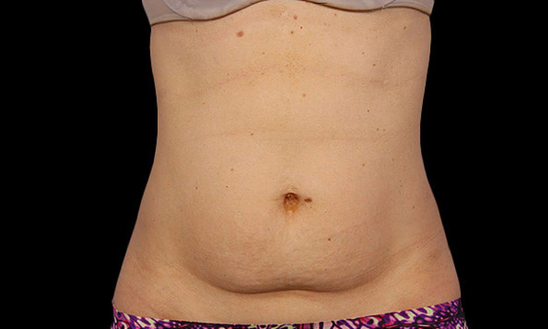 CoolSculpting Before woman mid section