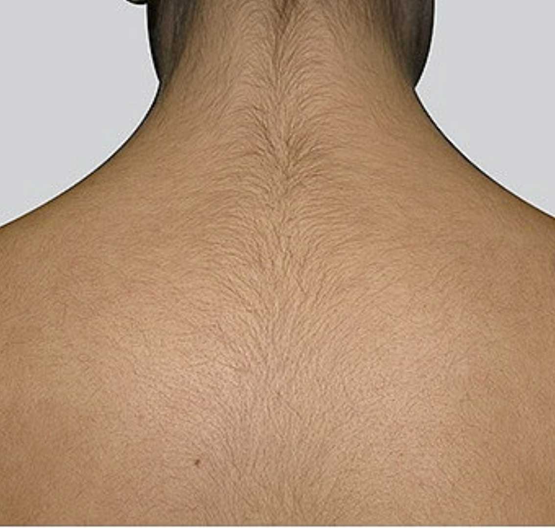 Laser Back Hair Removal Before