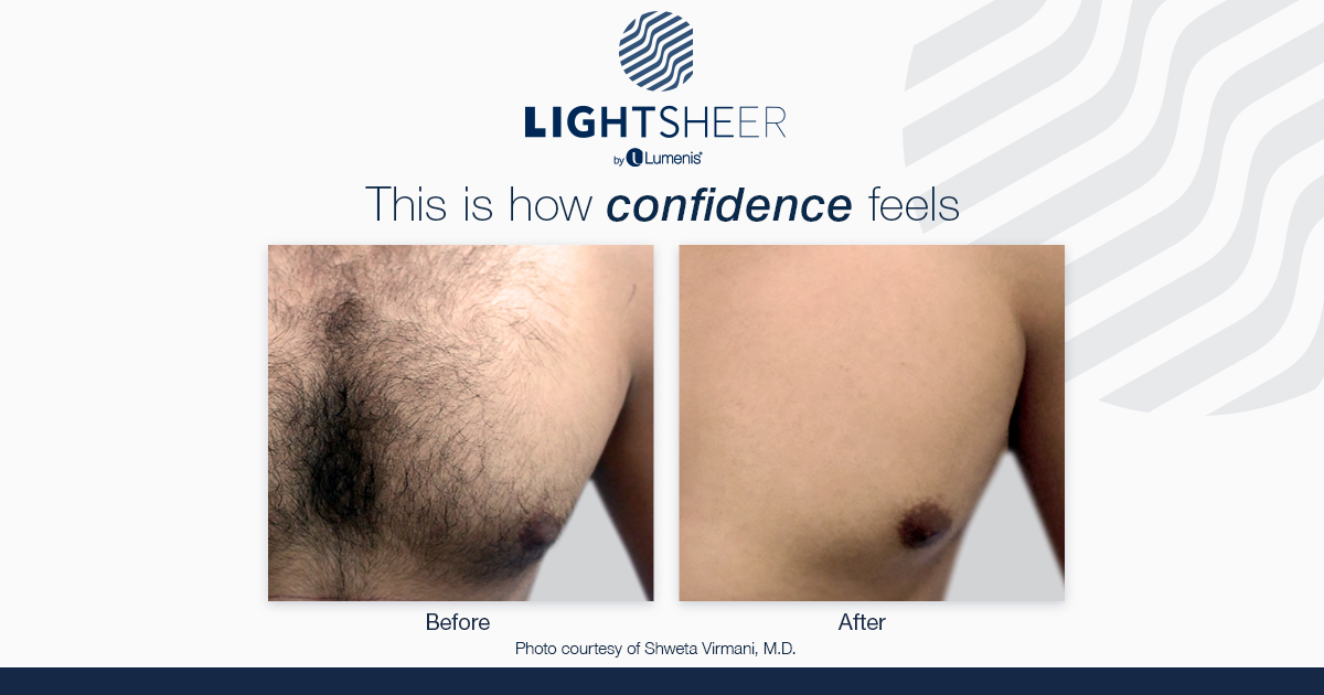Tallahassee Laser Hair Removal benefits